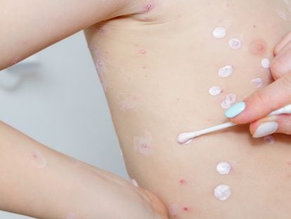 Una persona aplica crema hidratante sobre la piel de un niño con sarampión.