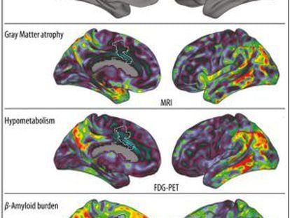 El gr&aacute;fico muestra (en rojo, arriba) el giro cingulado anterior donde se almacenan los recuerdos musicales. M&aacute;s abajo, visi&oacute;n bilateral de tres biomarcadores de Alzh&eacute;imer, en rojo las m&aacute;s afectadas.