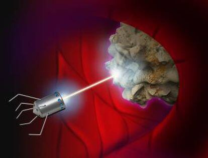 Recreación de un nanorobot destruyendo células cancerígenas.