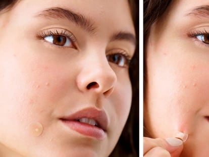 Este tratamiento para el acné te ayuda a desaparecer las imperfecciones de la cara