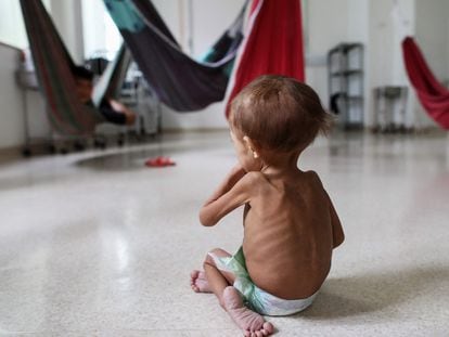 Un niño desnutrido de la etnia yanomami en un hospital pediátrico en Boa Vista, Estado de Roraima (Brasil), el 27 de enero.
