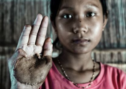 Eim Shok Kheng muestra las heridas que le provoc&oacute; el peque&ntilde;o proyectil de una bomba de racimo lanzada en la frontera de Laos y Camboya. Conoc&iacute;a el riesgo que entra&ntilde;aba el explosivo, parecido a una pelota de tenis, pero le pudo la curiosidad. Perdi&oacute; parte de dos dedos y de una pierna.
