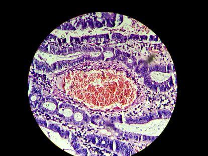 Un tumor de colon visto a través del microscopio.