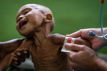 Un médico del hospital determina la gravedad de la desnutrición en un niño con el brazalete MUAC. Se trata de una cinta de plástico que se utiliza para medir el perímetro del brazo. Los resultados de la medición se dan en tres colores, dependiendo de su gravedad: verde (por encima de los 12,5 centímetros de circunferencia), indica que el niño está bien alimentado; amarillo (entre 11,5 y 12,5 centímetros), representa desnutrición moderada; rojo (menos de 11), indica desnutrición severa aguda que requiere de hospitalización urgente.