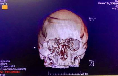 Radiografía del cráneo de Fabiola Campillai luego del disparo con armas no letales