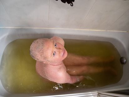 Ariadna López se toma un baño de alquitrán para hidratar su piel, descamada a causa de la ictiosis arlequín que padece.