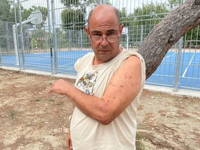 Paolo Barin enseña las cicatrices de las picaduras de las chinches. Hasta el jueves se alojaba en el Hostal Casa Sofía, en Tetuán.