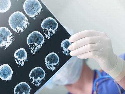 Un médico estudia el daño cerebral en un paciente.