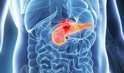 Ilustración de un páncreas con un tumor en el abdomen de una persona.