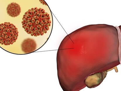 La hepatitis C, más cerca de erradicarse