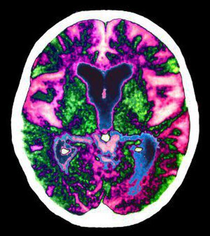 Imagen de un cerebro con alzh&eacute;imer.