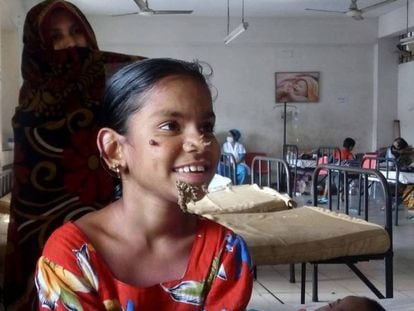 Sahana Katun, la primera &#039;mujer &aacute;rbol&#039; identificada, en el hospital de Dacca donde est&aacute; siendo tratada.