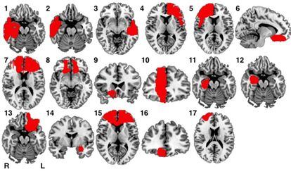 El escáner cerebral mostró que todas las lesiones se produjeron en zonas diferentes del cerebro. Aquí imágenes del de 17 de los criminales.