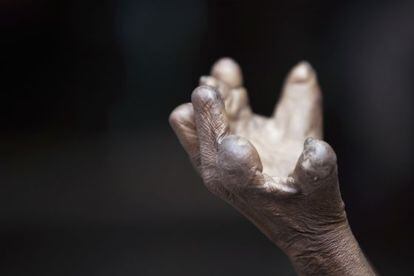 La mano de un enfermo de lepra 