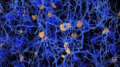Una imagen de placas amiloides entre las neuronas.