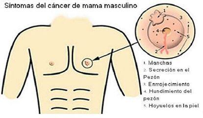 Algunos de los síntomas del cáncer de mama masculino.