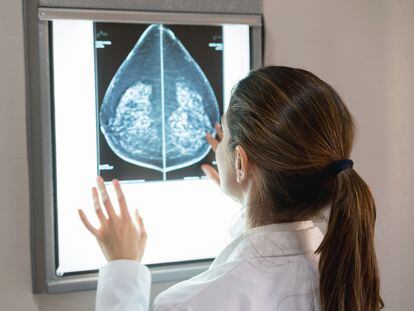 En 2022 se diagnosticaron 33.000 casos de cáncer de mama en España. Es el tumor más frecuente en las mujeres, pero también uno de los de mejor pronóstico, gracias a su diagnóstico precoz, al tratamiento personalizado y a la investigación.