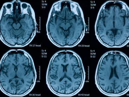 Un algoritmo detecta hemorragias cerebrales con más acierto que la mitad de los radiólogos