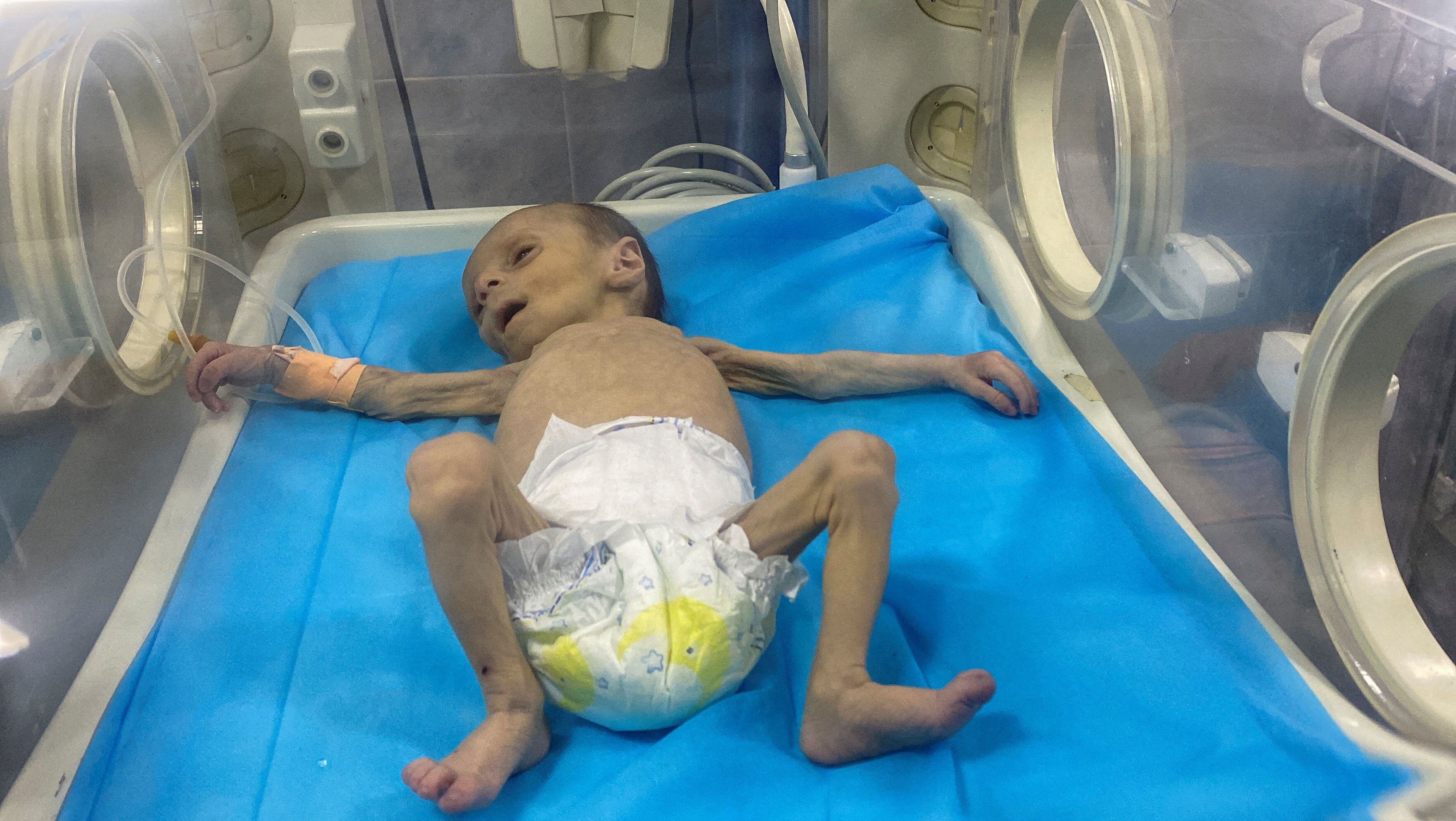 Una bebé palestina tratada por malnutrición severa en un hospital de Gaza este martes. 
