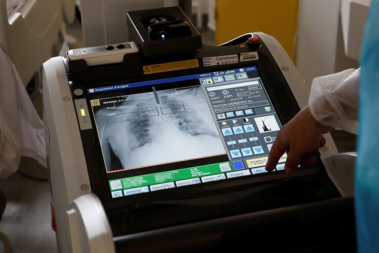 Radiografía de pulmón a un paciente con coronavirus en un hospital de París (Francia), el lunes.