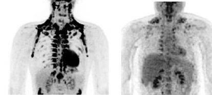 Imágenes de PET-TAC de grasa parda en una persona delgada (izquierda) y obesa.