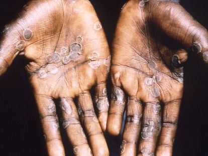 Fotografía de las lesiones provocadas por la viruela del mono, durante un estudio en la República Democrática del Congo entre 1996 y 1997.