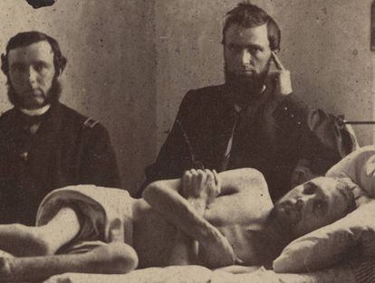 El cabo Calvin Bates, en el hospital tras salir del campo de prisioneros confederado de Andersonville. Atención, la foto ampliada puede herir su sensibilidad.