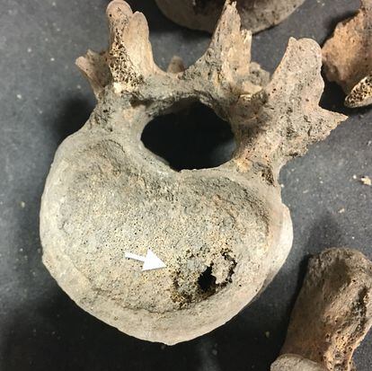 La imagen muestra un de las vértebras recuperadas de los cementerios medievales con una metástasis lítica indicada con una flecha.