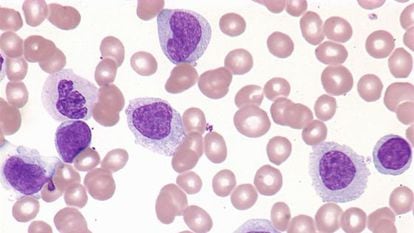 Muestra de células de una persona con Leucemia mielocítica aguda.