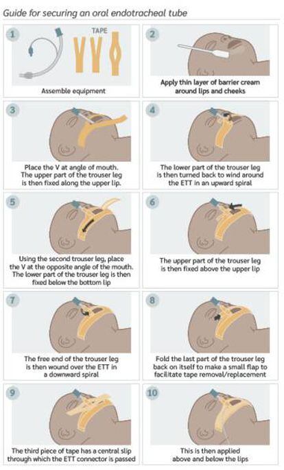 Ilustración de la guía pediátrica que explica cómo introducir un tubo endotraqueal en un niño.