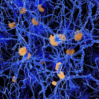 Alzheimers disease. Computer illustration of amyloid plaques amongst neurons. Amyloid plaques are characteristic features of Alzheimers disease. They lead to degeneration of the affected neurons, which are destroyed through the activity of microglia cells. The neurons are embedded in a network of astrocytes (darker cells).
