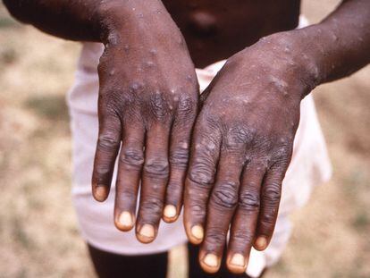 Primer plano de las lesiones de viruela del mono en las manos de un paciente durante la etapa de recuperación del virus, en República Democrática del Congo, en 1997.