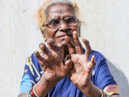 Jaibai Gaikowad, de 70 años, contrajo lepra hace 15, cuando aun se tardaba en detectar y tratar.