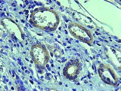 Vasos patològics (cercles blancs) amb abundant expressió de la proteïna CPEB4, en teixit cirròtic.