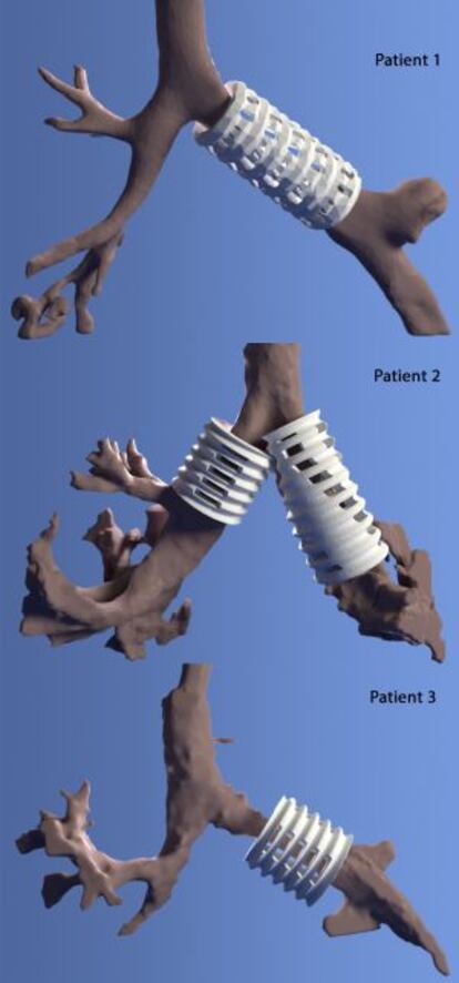 Las férulas a implantar en los tres niños se diseñaron digitalmente antes de imprimirlas.