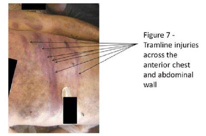 Heridas en el pecho y en el abdomen de un cadáver producidas por los golpes propinados con una barra.
