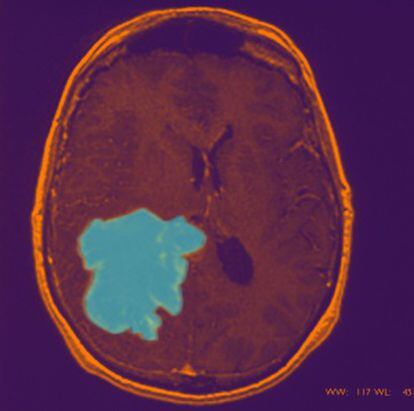 Imagen coloreada de glioblastoma. Con células diseminadas que han invadido la región cortical.