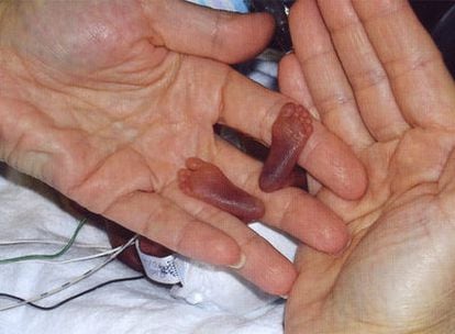 El nacimiento en 2006 de Amillia Taylor en Miami,  con menos de 22 semanas de embarazo, fue un <i>milagro</i> del avance de la medicina.