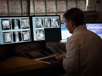 Un radiólogo observa una radiografía de cadera.
