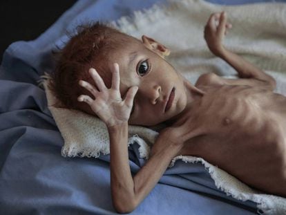 Niño víctima de malnutrición en Yemen, en un hospital de Hajjah en octubre.