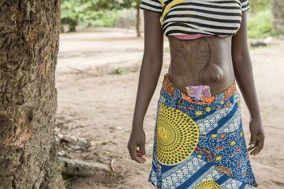 Fatondju, tras varias operaciones y casi cuatro meses hospitalizada por una úlcera de Buruli, ha podido retomar su vida en su pueblo, Yago (Benín).