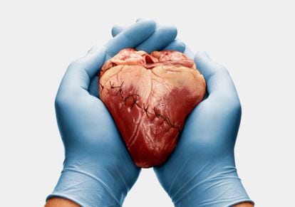 La cardiomiopatía dilatada es uno de los motivos de trasplante de corazón.