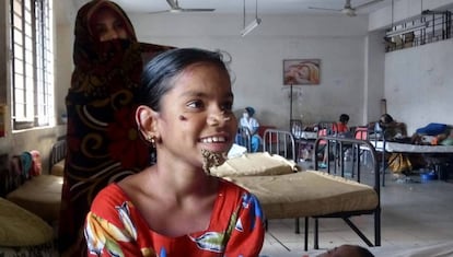 Sahana Katun, la primera 'mujer árbol' identificada, en el hospital de Dacca donde está siendo tratada.