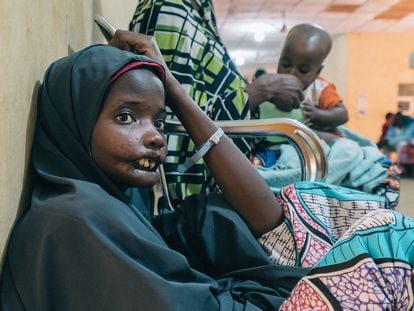 Amina, una paciente de noma de 18 años del estado de Yobe (Nigeria), en una visita al Hospital Sokoto Noma. Ella es una de las protagonistas del documental 'Restoring Dignity', de los cineastas franceses Claire Jeantet y Fabrice Catérini, producido por Inediz en colaboración con Médicos sin Fronteras (MSF).