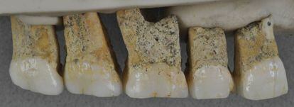 Dientes superiores del CCH6 individual, el espécimen tipo de la nueva especie Homo luzonensis.
