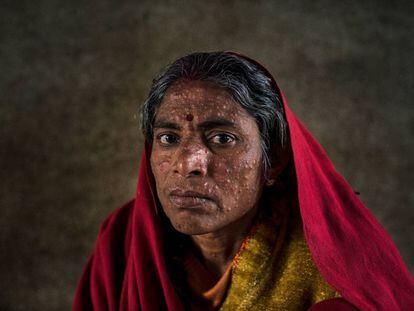 Una paciente de leishmaniasis en un hospital de MSF en Hajipur (India).