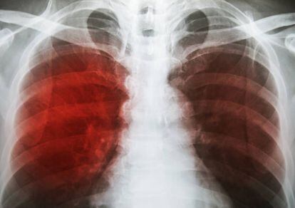 Radiografía de tórax muestra infiltración alveolar en ambos pulmones debido a infección por microbacterias tuberculosas.