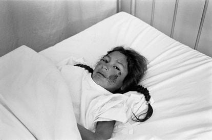 Niña herida en un ataque de la organización terrorista Sendero Luminoso, en el hospital de Huanta, Pampacancha. Perú, 1984.