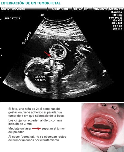 Fuente: American Journal of Obstetrics & Gynecology.
