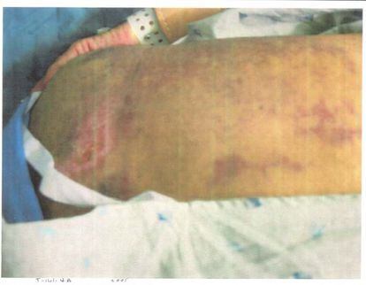 Imagen de heridas y magulladuras en una pierna procedente del archivo de fotografías de las campañas de Irak y Afganistán revelado por el Pentágono